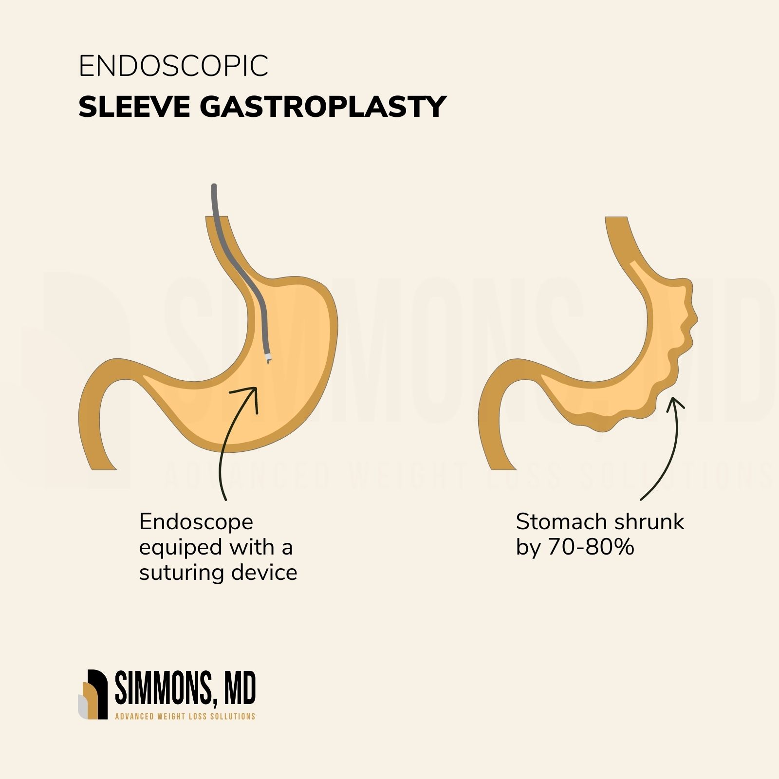 https://simmonsweightloss.com/wp-content/uploads/2023/03/Endoscopic-sleeve-gastroplasty.jpg